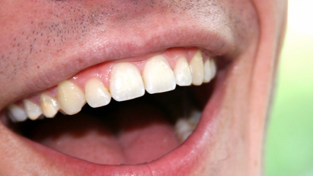 Chega em Goiânia , a nova superfície SLActive ® do implante dentário Straumann