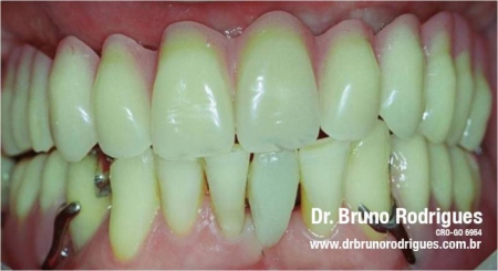 Prótese de acrílico sobre 4 implantes arcada superior