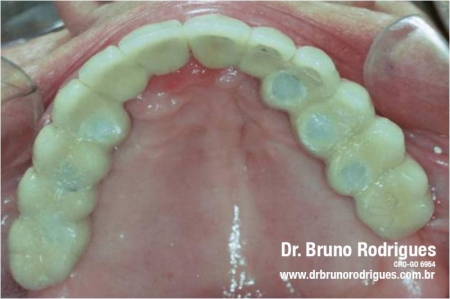 Prótese sobre implantes boca total superior e inferior de porcelana
